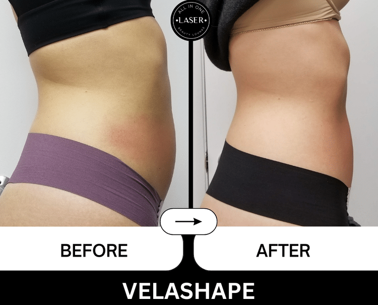 VELASHAPE+(3)LK