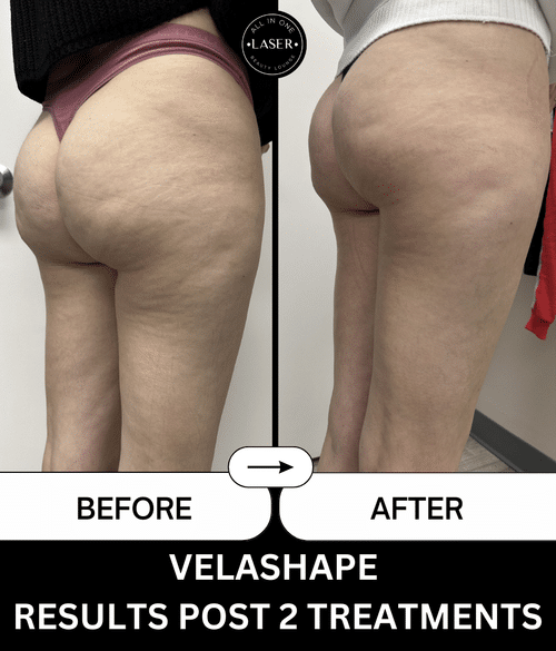 VELASHAPE+RESULTS+POST+2+TREATMENTS