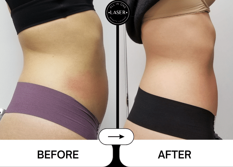 VELASHAPE3LK