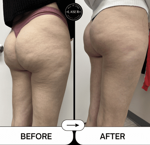 VELASHAPERESULTSPOST2TREATMENTS
